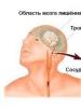 Felçte darbe saldırısı Tromboliz - felç tedavisinde etkili bir yöntem