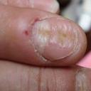 Види дистрофії нігтів (фото), як лікувати!