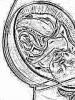 Atașarea marginală a cordonului ombilical de placentă: cauze, riscuri, cum evoluează sarcina Atașarea vasculară a cordonului ombilical de placentă