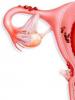 Endometriozis için IVF: Sonuç olacak mı?