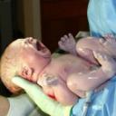 Doğum sırasında bebeği sıkmak